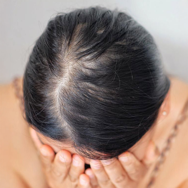 alopecia