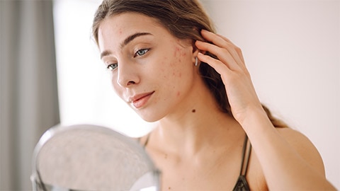Beauty Q: Hoe verzorg ik mijn onzuivere huid? Beauty Q: Hoe verzorg ik mijn onzuivere huid?