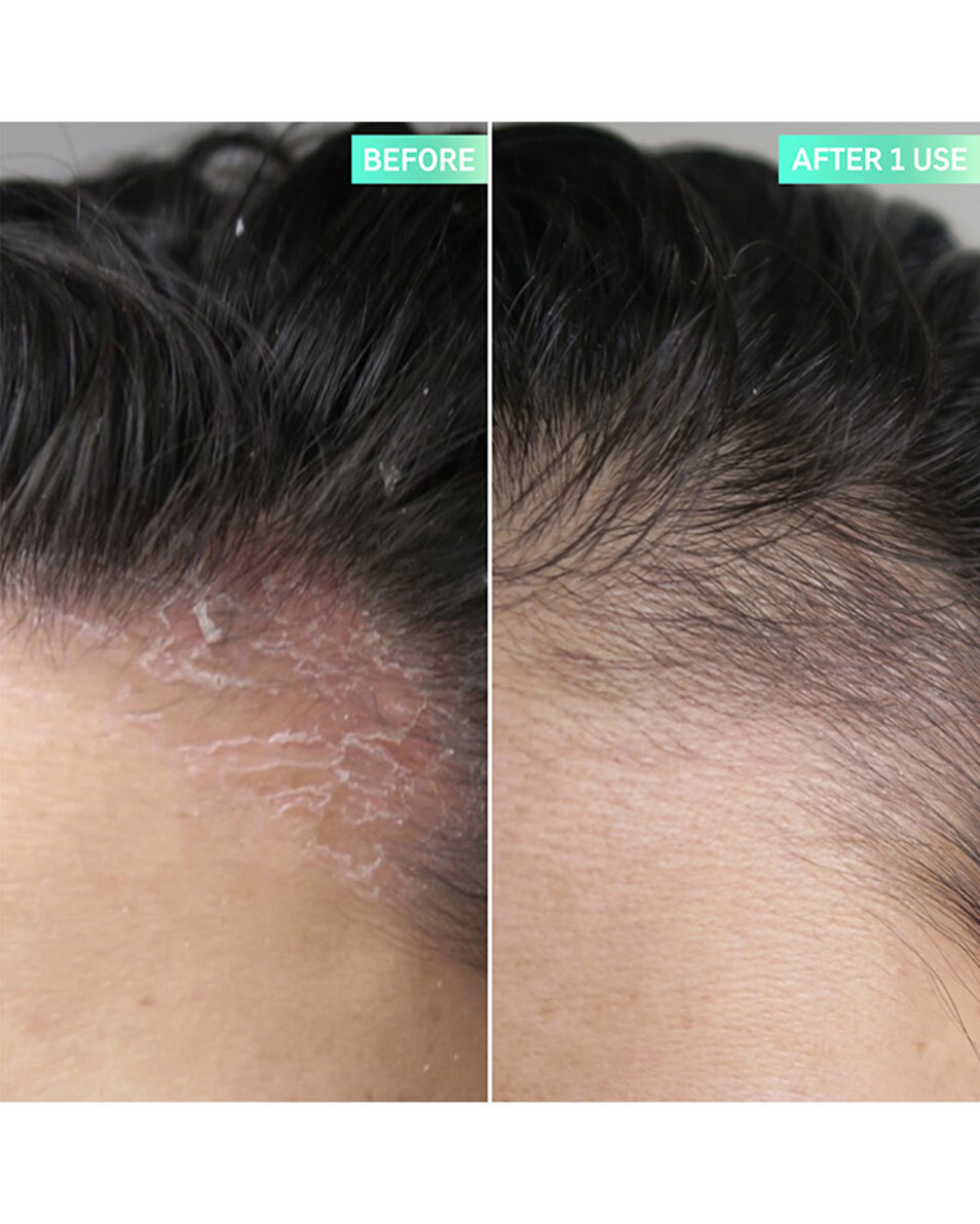 EXFOLIËRENDE HOOFDHUIDBEHANDELING MET SALICYLZUUR