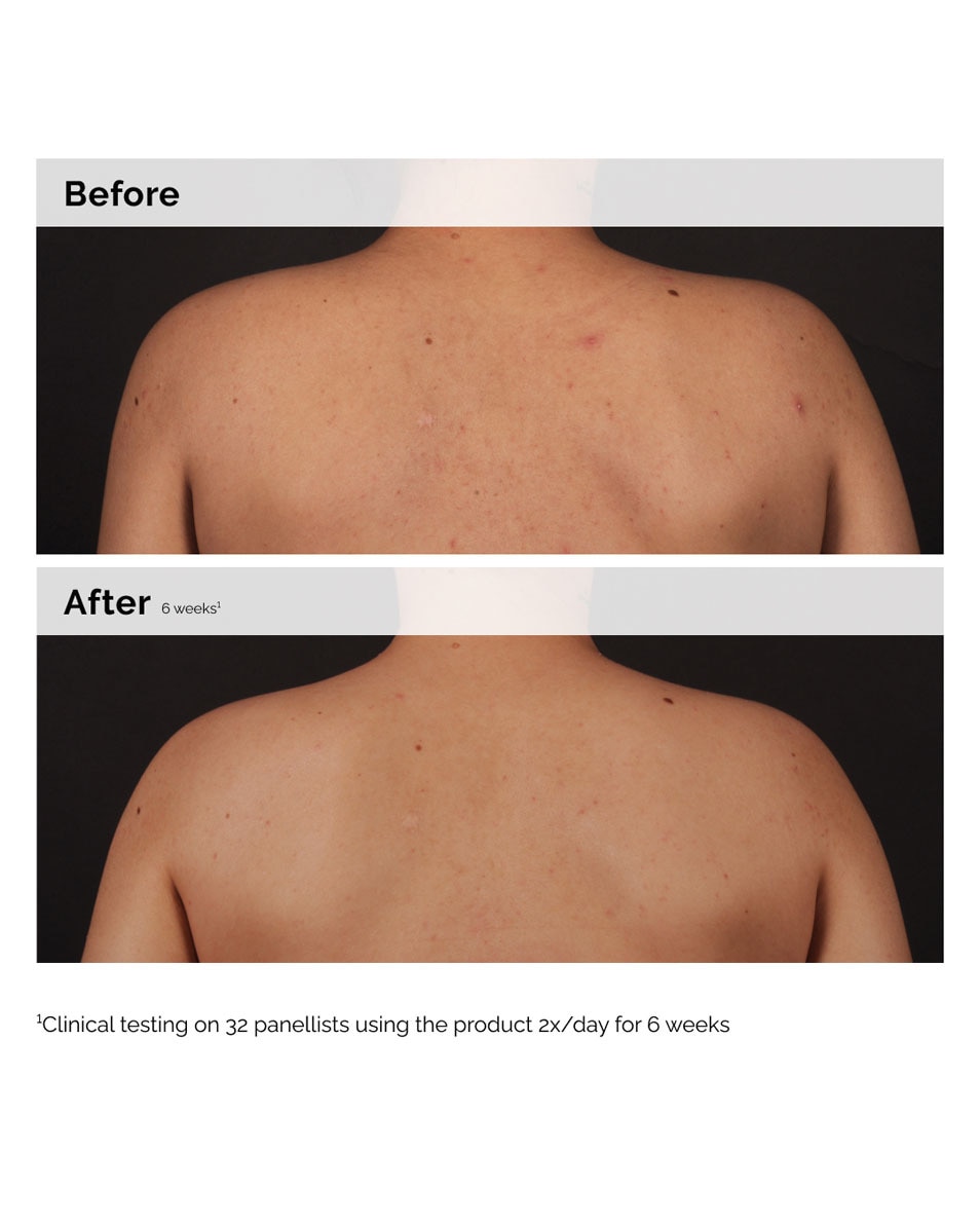 THE ORDINARY SIGNS OF CONGESTION SALICYLIC ACID 0.5% BODY SERUM 240 ML 3