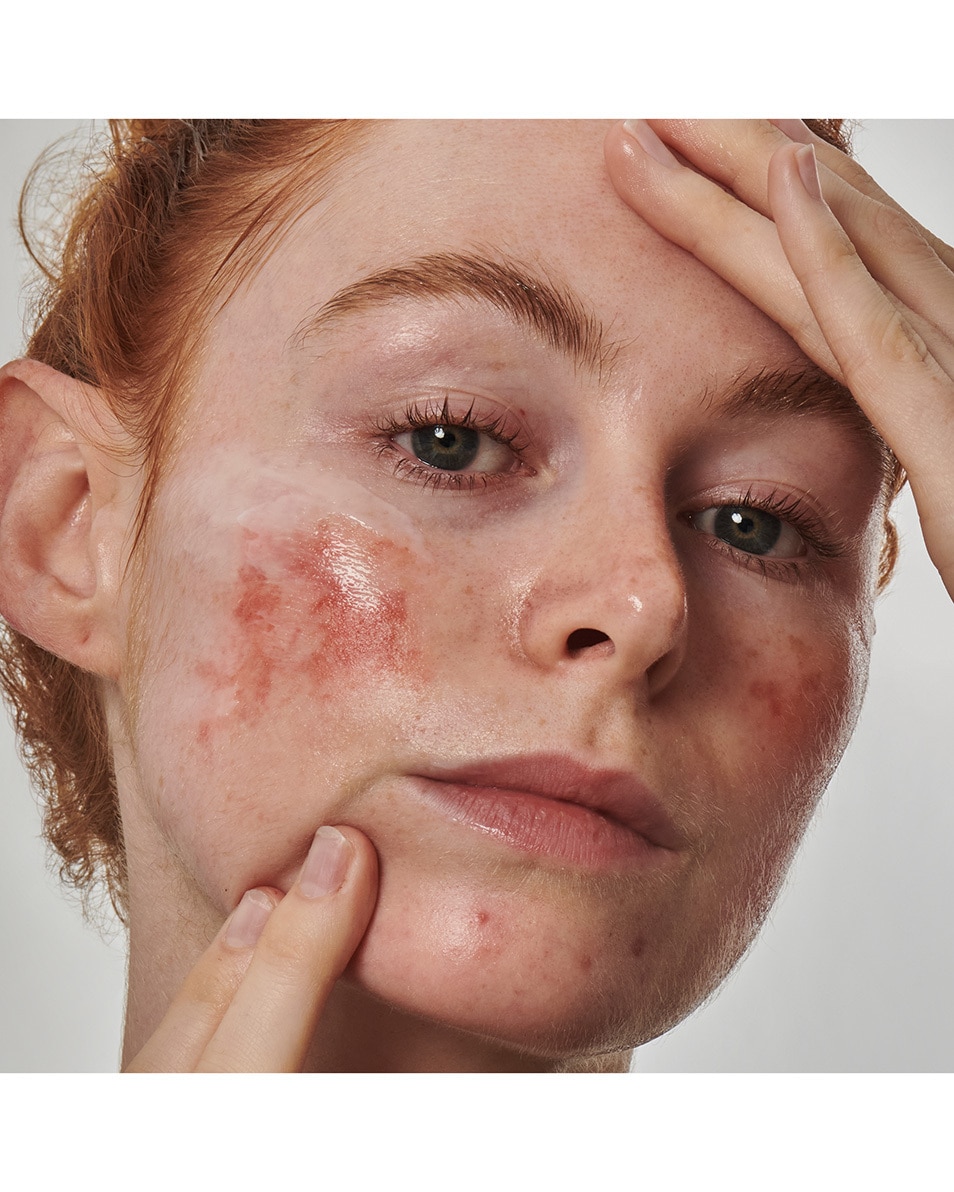 SUPERSOLUTIONS 10% AZELAIC ACID SERUM