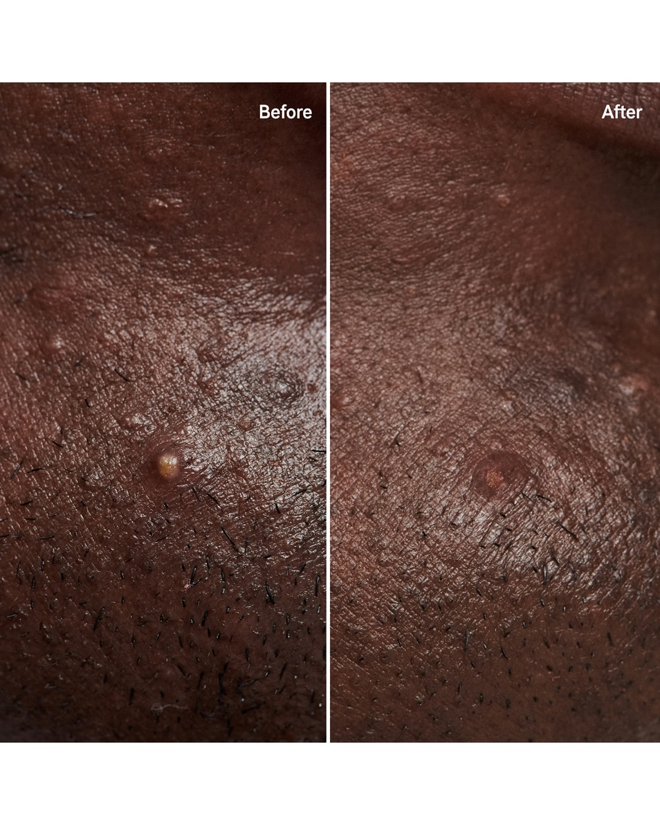 The Inkey List Pimple patch Hydrocolloïde pleisters voor onzichtbare puistjes 22 ST 2