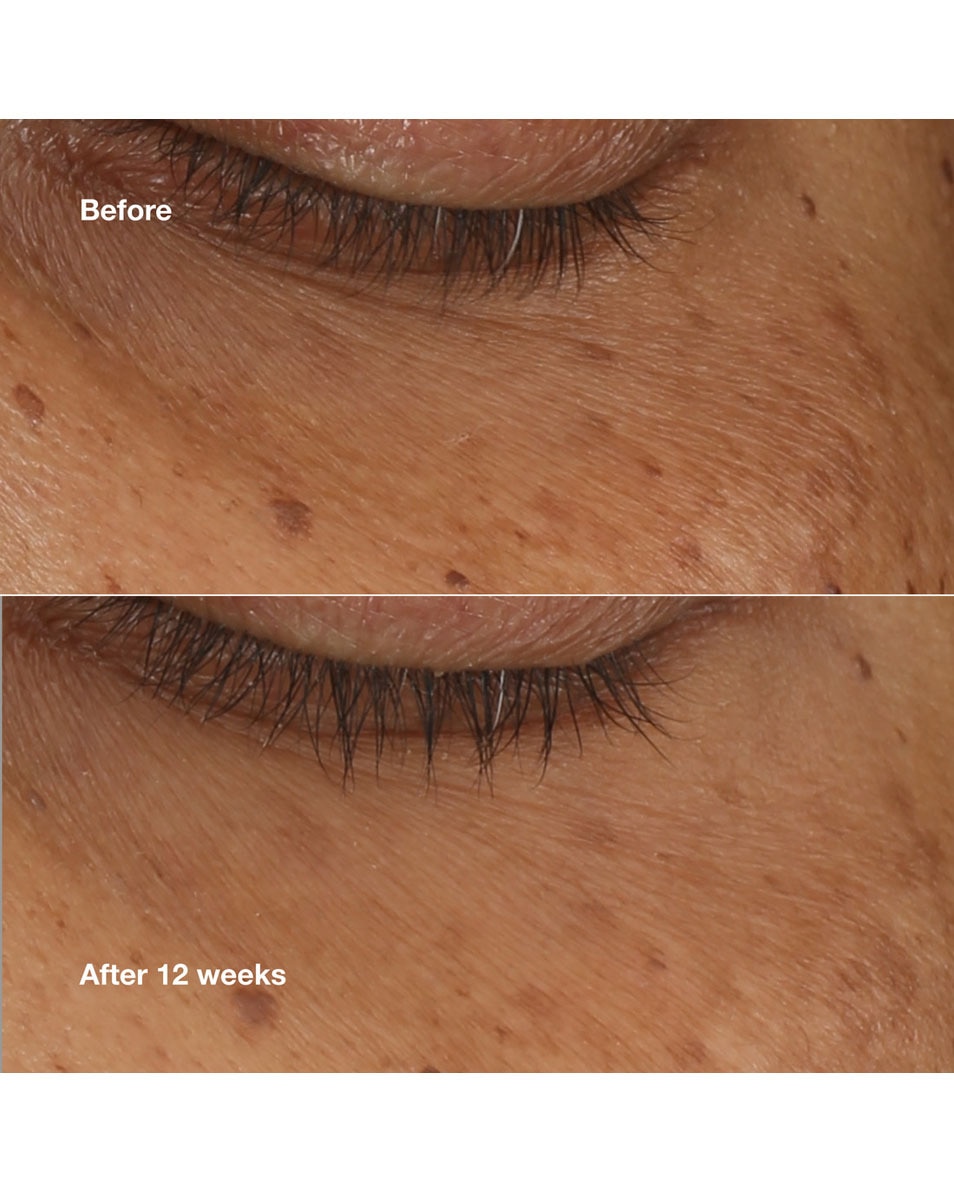 Donkere kringen en wallen tegen gaan